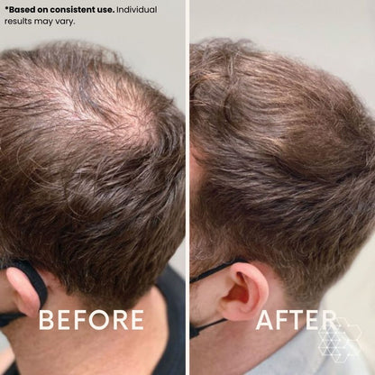 Anteku | Hair Revive Dual Red Light Therapy Hat