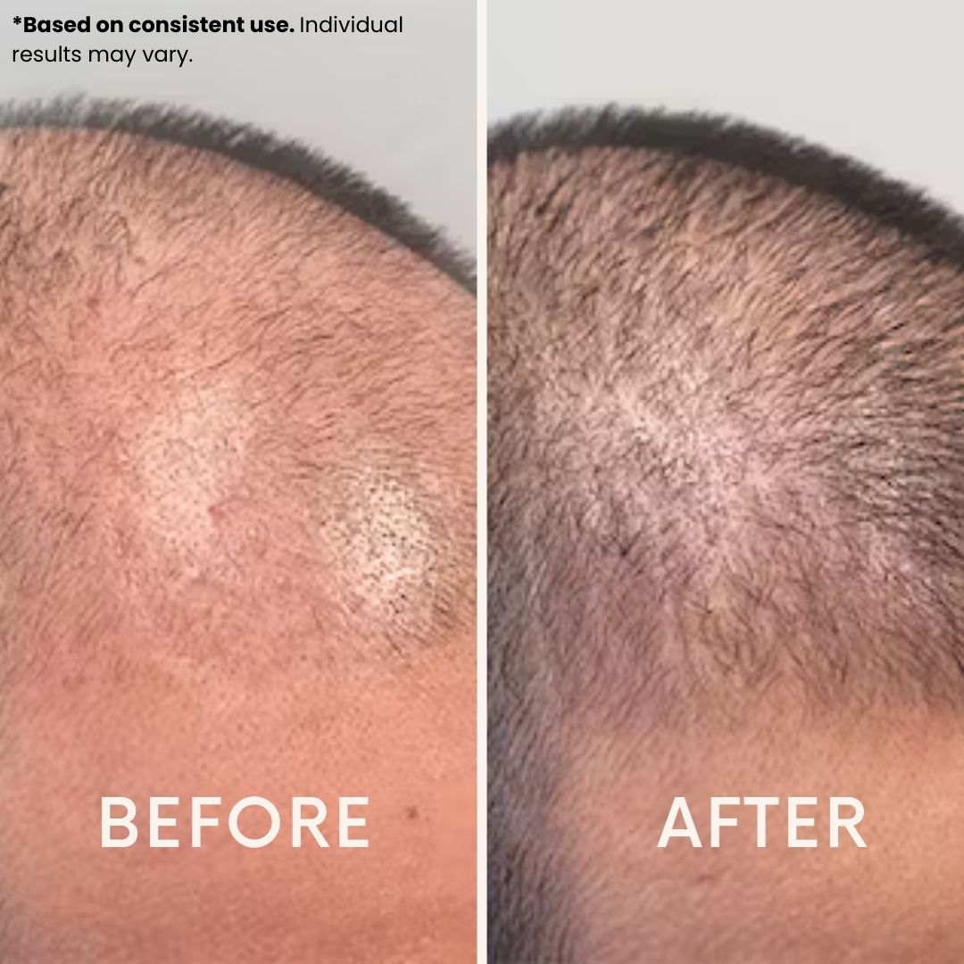 Anteku | Hair Revive Dual Red Light Therapy Hat