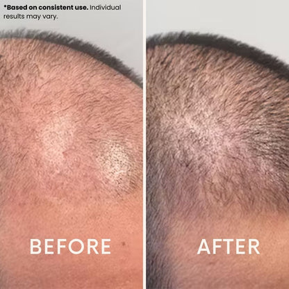 Anteku | Hair Revive Dual Red Light Therapy Hat