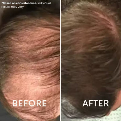 Anteku | Hair Revive Dual Red Light Therapy Hat