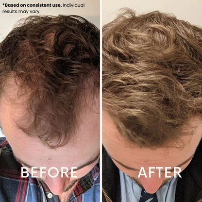 Anteku | Hair Revive Dual Red Light Therapy Hat