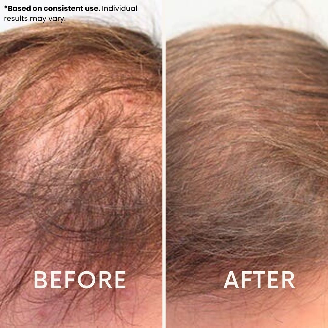 Anteku | Hair Revive Dual Red Light Therapy Hat