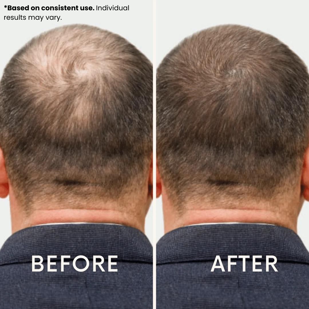 Anteku | Hair Revive Dual Red Light Therapy Hat