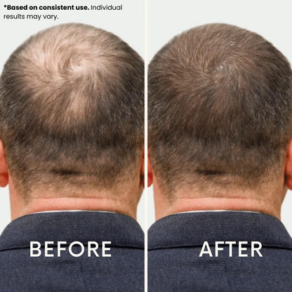 Anteku | Hair Revive Dual Red Light Therapy Hat